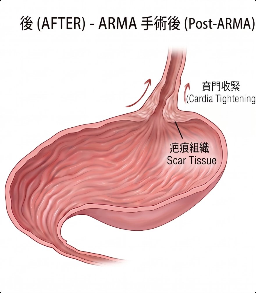 術後:ARMA 手術後賁門收緊示意圖