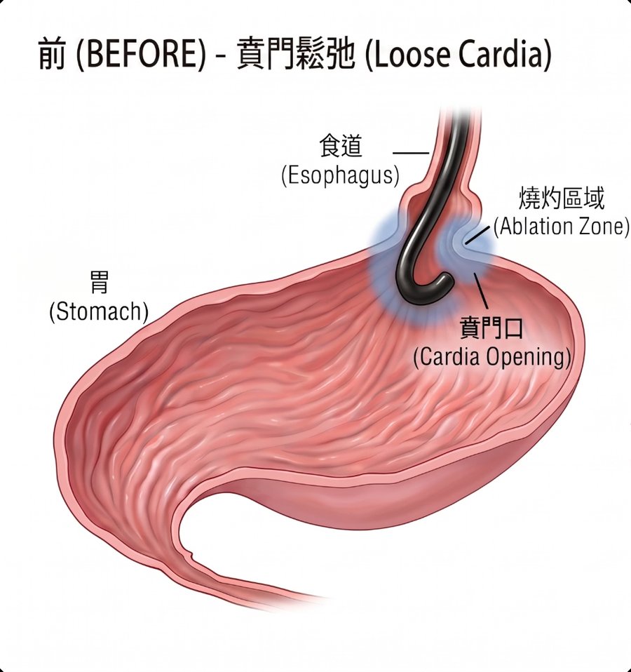 術前:賁門鬆弛(Loose Cardia)示意圖
